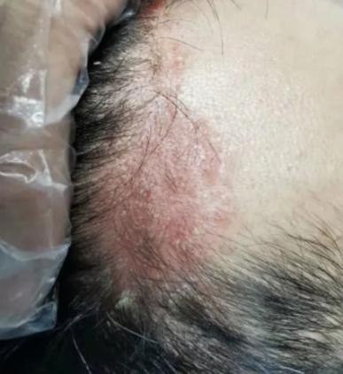 头皮有红斑、掉屑,不一定是脂溢性皮炎!还有可能是这3种头皮疾病