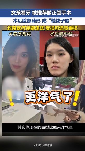 女孩看牙 被推荐做正颌手术 术后脸部畸形 成“鞋拔子脸” 过度医疗涉嫌违法 受损可追责维权 | 冀时新闻主播说